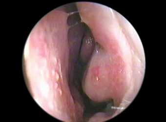 Right Left Polyp (0, 1, 2) Edema (0, 1, 2) Secretion (0, 1, 2) Total Note: polyp: 0-absent; 1-limited to the middle meatus; 2-extending to the nasal cavity Mucosa edema: 0-absent; 1-mild/moderate