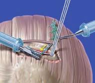 the rotator cuff Removal of disposable inserter and