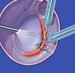 cannula and retrival of the white an blue-white sutures via the anterior-inferior cannula.