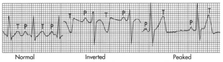 T Waves Represents ventricular repolarization Slightly asymmetrical Usually oriented in the same