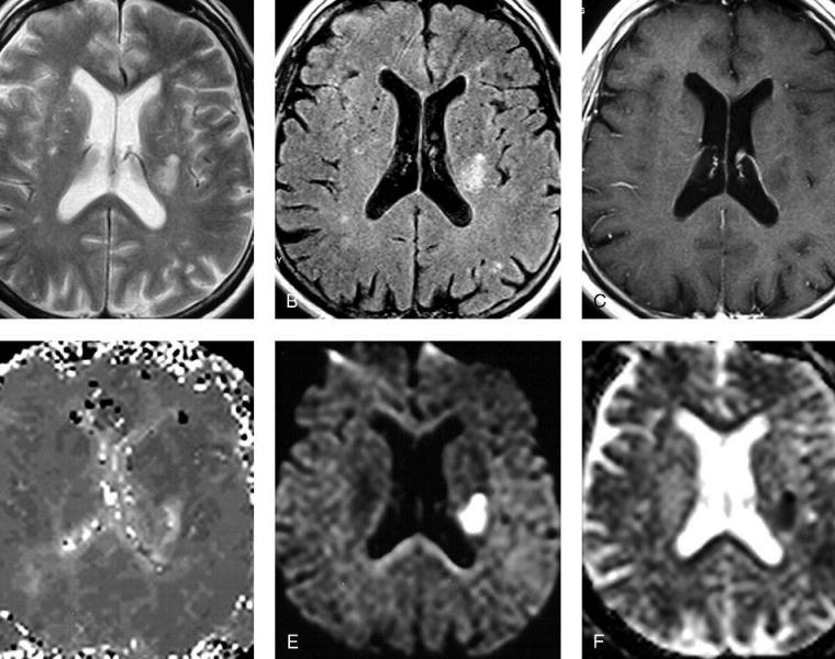 Investigations MRI scan of brain in: