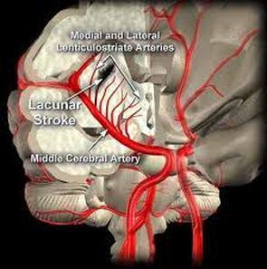 Aetiologies of Ischemic Stroke (contd) Lacunar infarction Miscellaneous Blood disorders Other non-atheromatous
