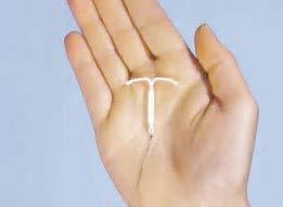 What is LARC Long-acting reversible contraception (LARC) methods include the intrauterine device (IUD) and the birth control implant.