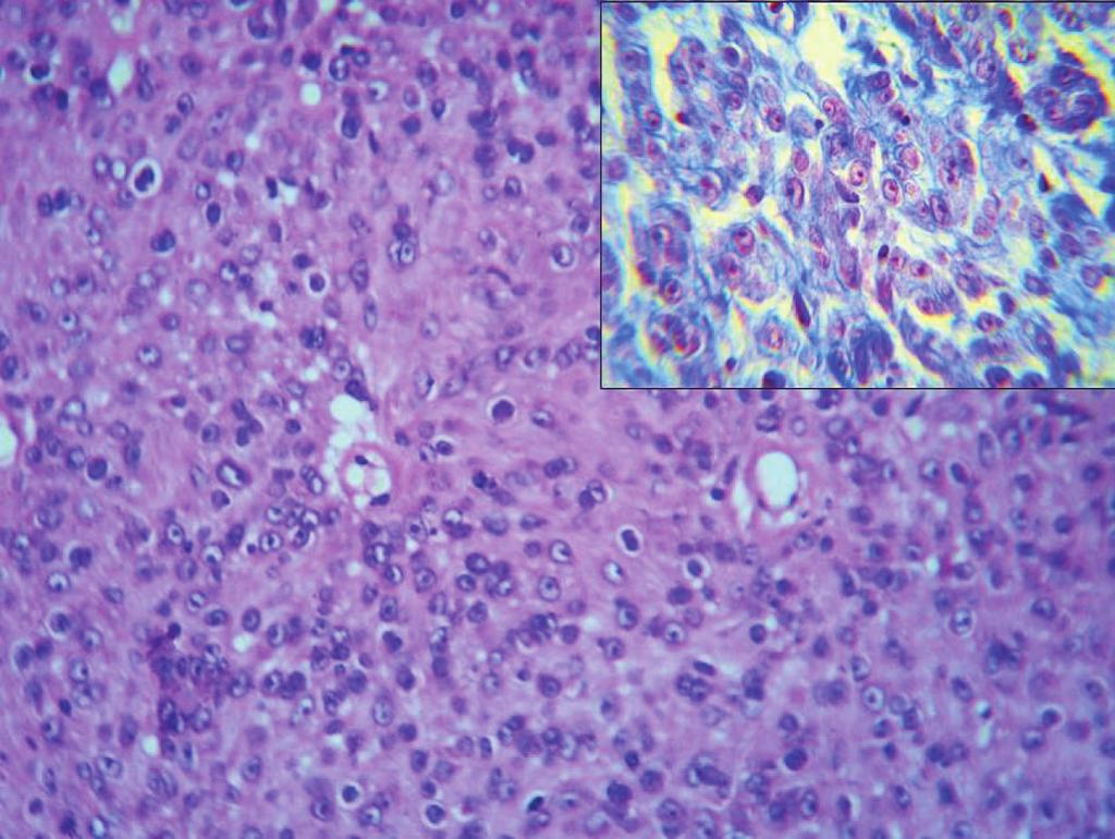With the constellation of light microscopical, cytochemical and immunohistochemical findings, a diagnosis of epithelioid schwannoma was given.