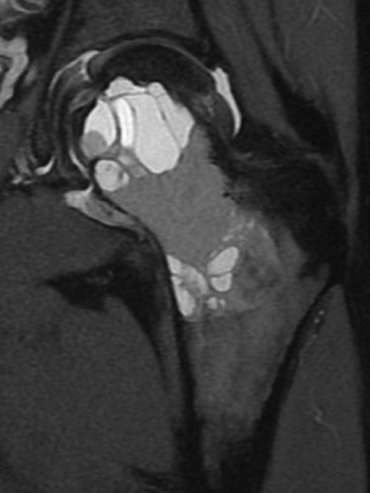 neck, which can be more clearly seen on MRI. Radiograph (c) at six months after curettage and grafting with an ipsilateral non-vascularised fibular graft and morsels of allograft.