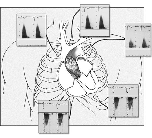 Angels at which to evaluate aortic outflow velocity by Doppler in evaluation of aortic