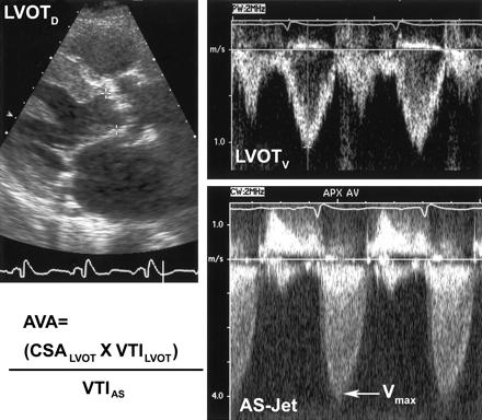 Severity of aortic stenosis by valve area calculation: