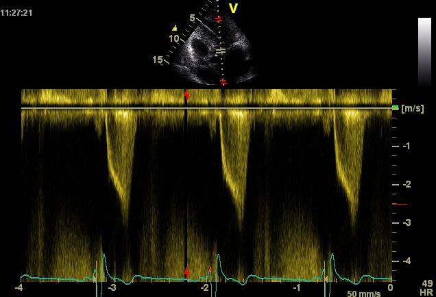 LV outflow tract Doppler shape in Hypertrophic Cardiomyopathy with obstruction