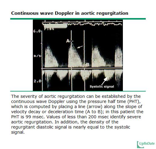 Aortic Regurgitation: Apical 5 chamber, Rate of degradation of signal