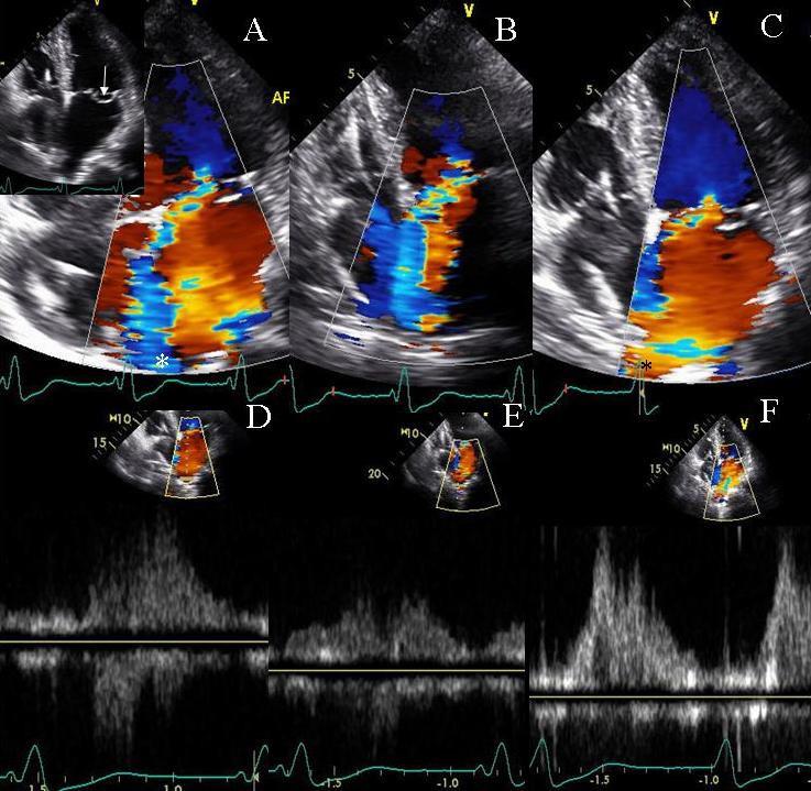 Mitral Regurgitation severity by color Doppler Visual clues (subjective): jet reaches the top of the atrium,