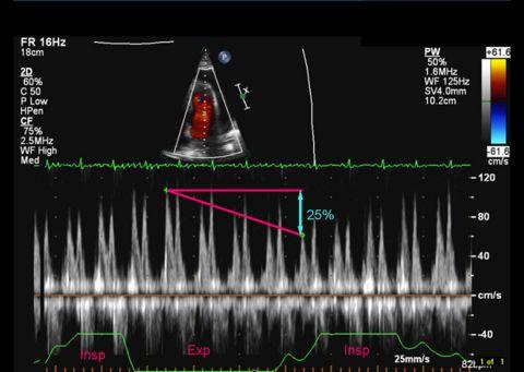 Respiratory variation in mitral and tricuspid