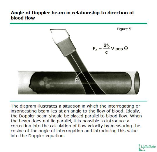 Doppler measurement is best when beam