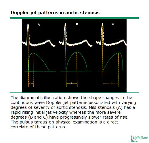 Aortic Stenosis Doppler shape can vary depending on severity (delay in