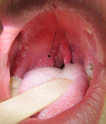 Peritonsillar Abscess Symptoms Muffled (Hot Potato) voice Uvular deviation (Asymmetric