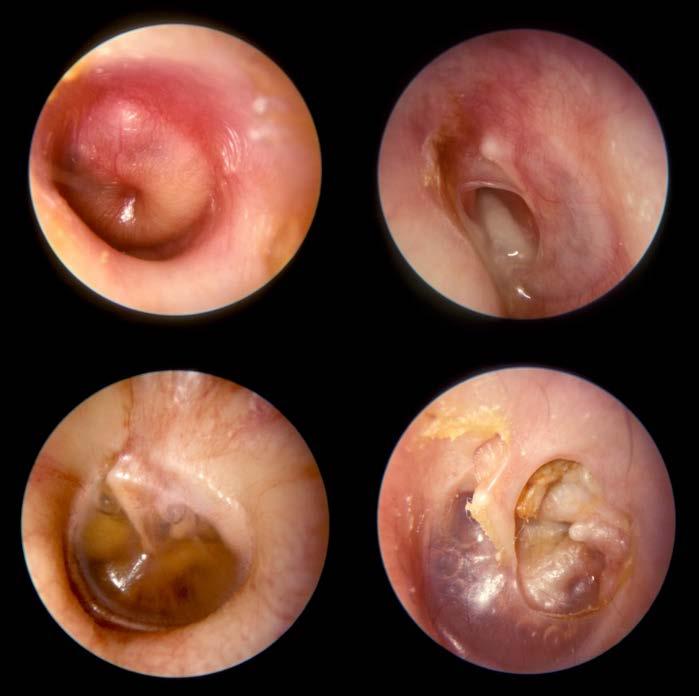 Ear Pathology Otitis Media Recurrent Acute Otitis Media Chronic Otitis Media Complications of