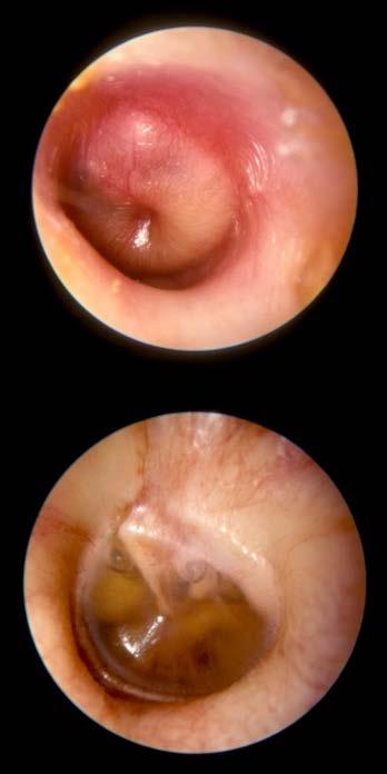 Otitis Media Definitions Recurrent AOM >3 separate AOM episodes within 6 months.