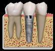 Gingival sulcus measures 4mm inter-proximally, 2mm facially When the intratooth space is 8 to 12 mm When the intratooth space is 12-14 mm When the intratooth space is 14 mm When the