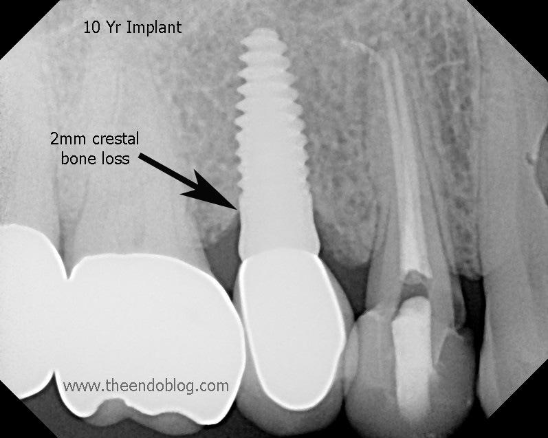 PERIODONTAL (CLINICAL) INDICES- MISCH 2008 ICOI Radiographic Crestal Bone Loss 0.1-0.