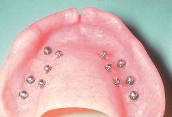 inserts Titanium blade implants were introduced in the 1960s but success was short