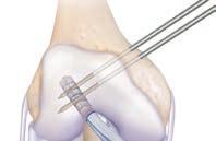 the medial femoral condyle (Figure 13). 7.