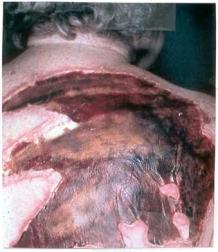 IMAGE OF FULL THICKNESS BURN TO BACK In a full thickness burn, the zone of injury can readily extend below
