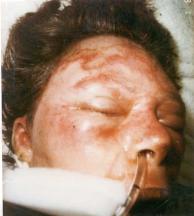 Note: Edema developing below the zone of coagulation is very prominent in facial burns B) Anatomic Assessment Of The Burn Wound Burn depth is defined based on the depth of coagulation necrosis into