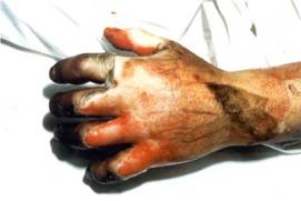 4) Full Thickness Burn Necrosis of entire dermis including all epidermal elements edema diffuse beneath eschar Characteristics white, dry or char In a full thickness burn both