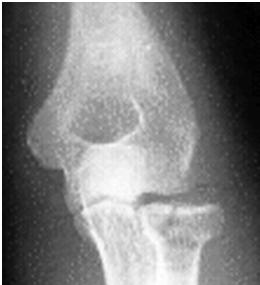Radial Head Fracture This is an