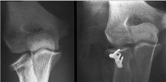answer Radial Head Fracture What to do