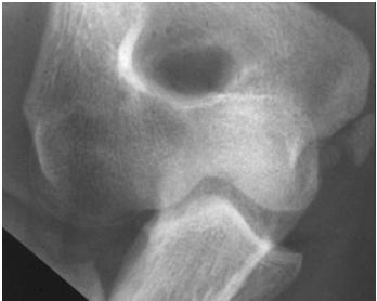 Radial Head Fracture What not to do?