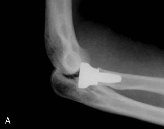 Anterior Elbow Capsulodesis FIGURE 3. A, A lateral radiograph showing residual posterior subluxation of the ulnohumeral and radiocapitellar joints before an anterior elbow capsulodesis.