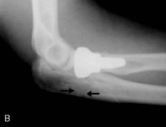 Note the transosseous suture holes (arrows) in the proximal ulna. to resist the posteriorly directed joint reactive forces produced by the biceps and triceps muscles.