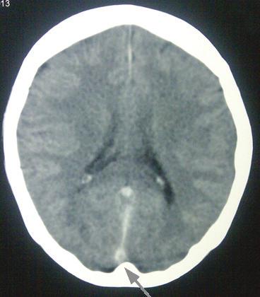 Case Report Early recognition of cerebral venous sinus thrombosis than left side with power of 2/5 compared to 3/5. Her reflexes were brisk and plantars were down going bilaterally.