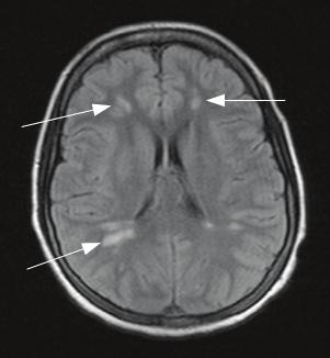 There was a low-density filling defect in the posterior part of the sagittal sinus, also known as an empty delta sign.