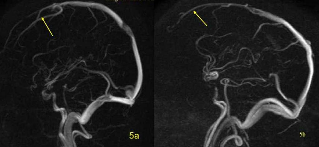 5: Superior Sagittal Sinus 5a Hypoplasia of anterior 25% of