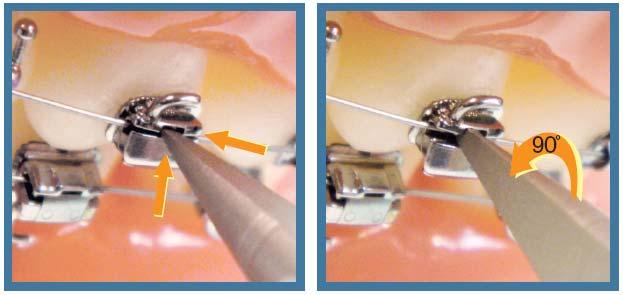 SnapLink Opening/Closing Instrument Features & Benefits Features Size-calibrated flattened tip on anterior end ensures
