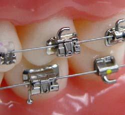 Background Buccal tubes are attached to the upper and lower molars to anchor the distal ends of archwires, or to attach an auxiliary wire, headgear or lip bumper, or as an attachment and anchor for