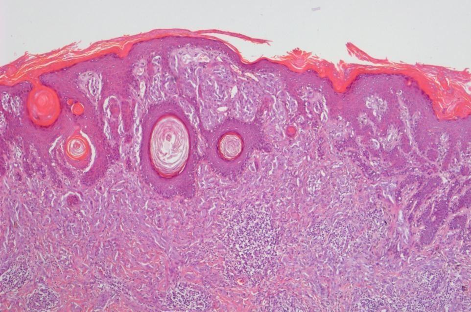 2mm Figure 3-31 Photomicrograph of case 3