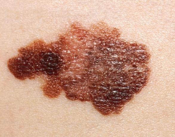 features of melanoma are summarised in both the ABCDE criteria, (detailed in table 1-2) (13) and the Glasgow seven point checklist (detailed in table 1-3) (14), both of which have been developed as