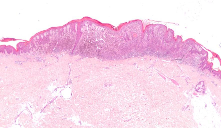2mm 2mm Figure 2-1 Malignant melanoma (above) and a histological section from the same lesion following manual microdissection (below).