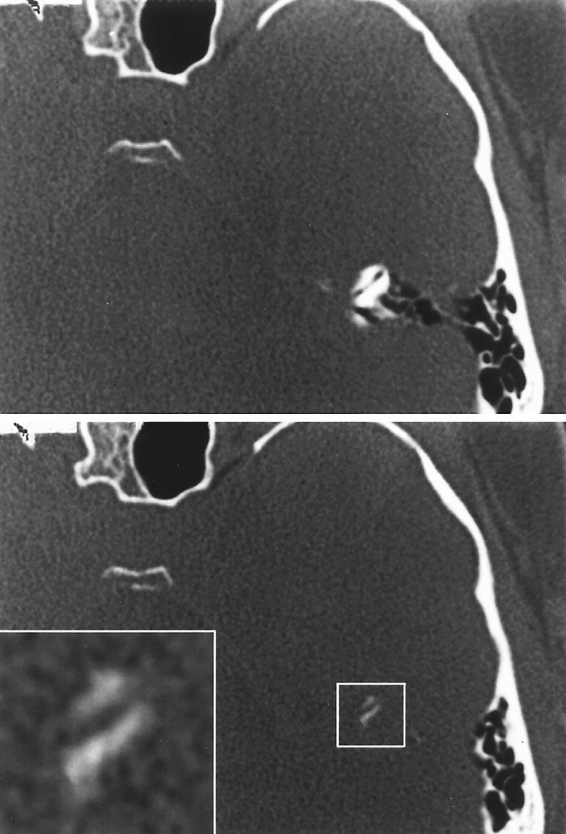 Figure 8. Operative photograph at the time of middle cranial fossa exploration in patient 2.