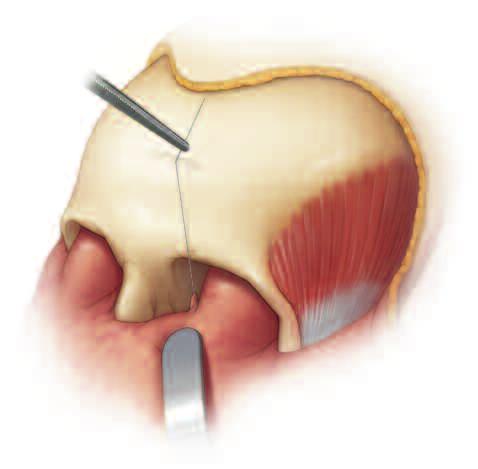 medial to the canthus) toward the inside of the coronal flap.