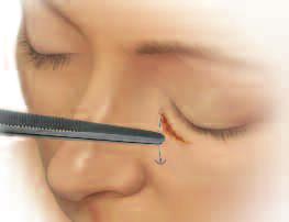 Instead of a skin incision below the lid margin, an incision can be made in the caruncula.