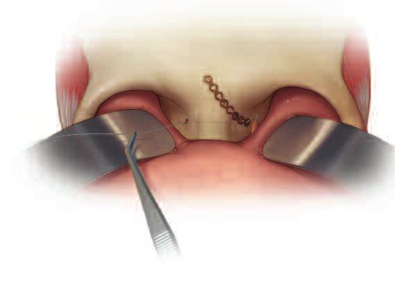 The use of a transnasal awl may help facilitate wire passing.