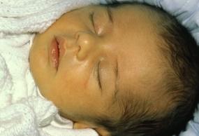 Prolonged neonatal jaundice