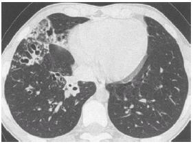 pneumonia Severe