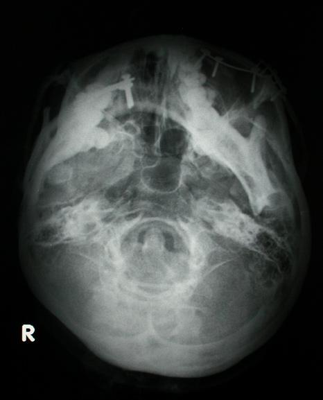 bone obstacles (left); PA skull x-ray showing right condylar neck