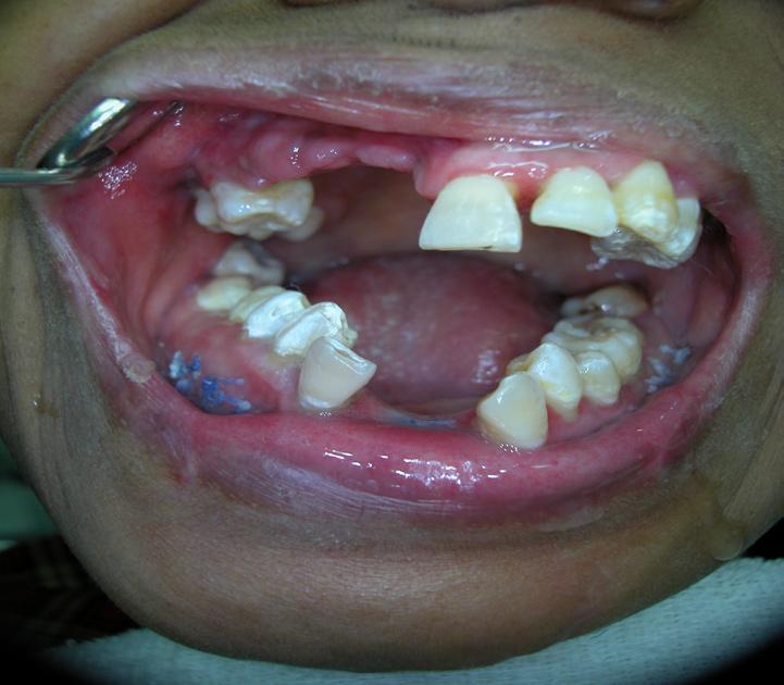 Mouth opening ten days after surgery of right joint a gap