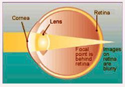 Hyperopia: Far-Sightedness (Can t focus on close objects) Eyeball is too short causing light to focus