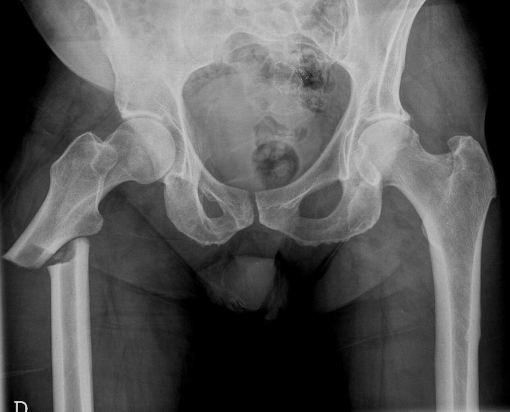 Atypical Fractures O Strongest part of the femur subtrochanteric and diaphyseal region O Hx of prodromal thigh pain, circumferential cortical thickening and cortical